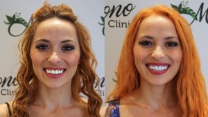 İzmir Zirkonyum Diş Yapımı ve Kullanımı