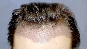 Saç Ekimi Uygulaması