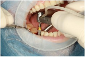 İMPLANT TEDAVİSİ KORKULU RÜYANIZ OLMASIN!!