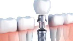 İmplant Tedavisi Nedir?