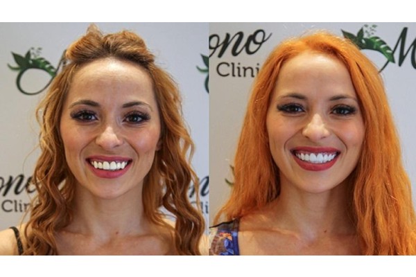 İzmir Zirkonyum Diş Yapımı ve Kullanımı