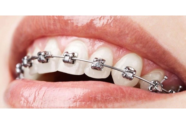 Ortodonti Tedavisi Nedir?
