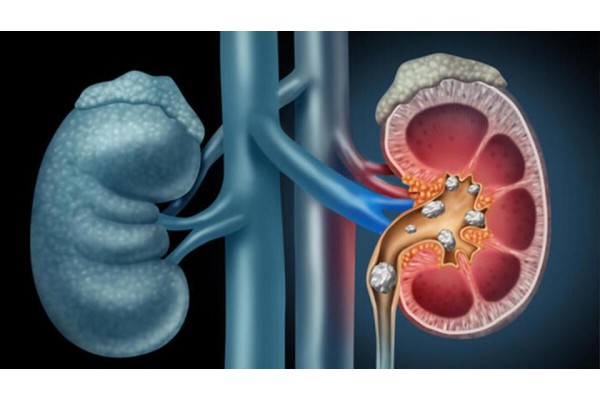 Böbrek Taşı Nedir?