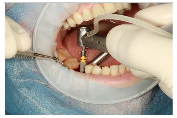 İMPLANT TEDAVİSİ KORKULU RÜYANIZ OLMASIN!!