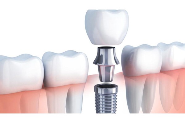 İmplant Tedavisi Nedir?