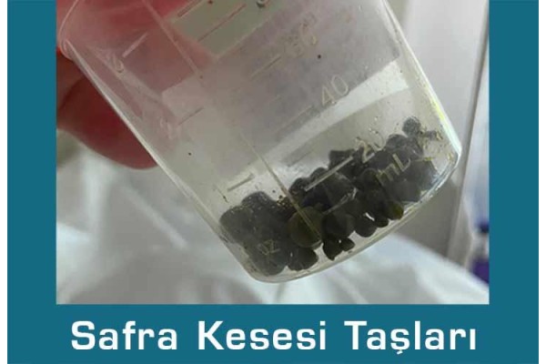 Safra Kesesi Ameliyatı